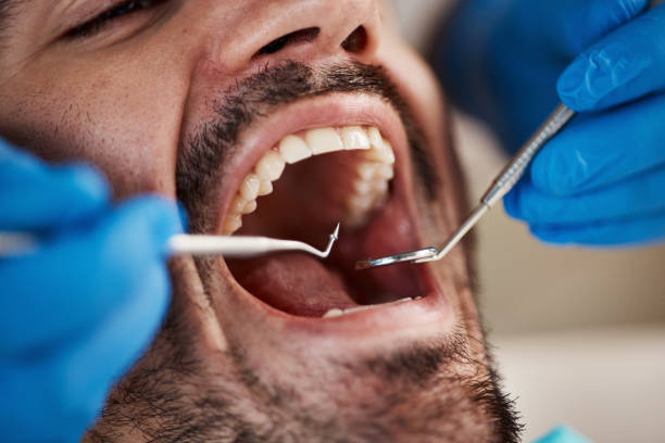 Best Emergency Wisdom Teeth Removal in Rainbow, CA