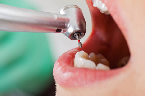 Best Emergency Tooth Extraction in Rainbow, CA